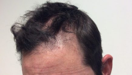 What Are The Needs To Consider Hair Transplant Treatment?