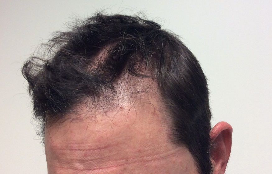 What Are The Needs To Consider Hair Transplant Treatment?