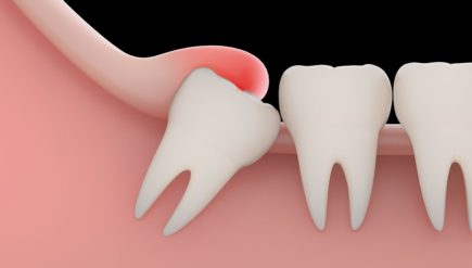 What to Know About Wisdom Tooth Extraction