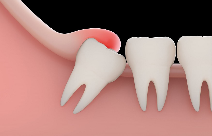 What to Know About Wisdom Tooth Extraction